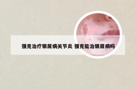 強克治療銀屑病關節(jié)炎 強克能治銀屑病嗎